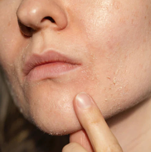 Natürliche Hilfe bei Hautkrankheiten:  Wie Swiss Tallow bei Rosacea und Neurodermitis unterstützen kann